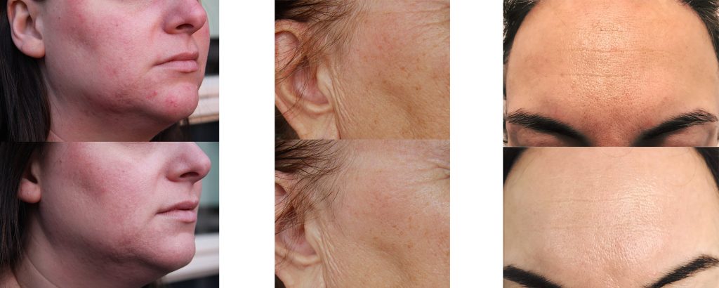 Resultaat Bio Peel kruidenpeeling: de huid voor en na de behandeling