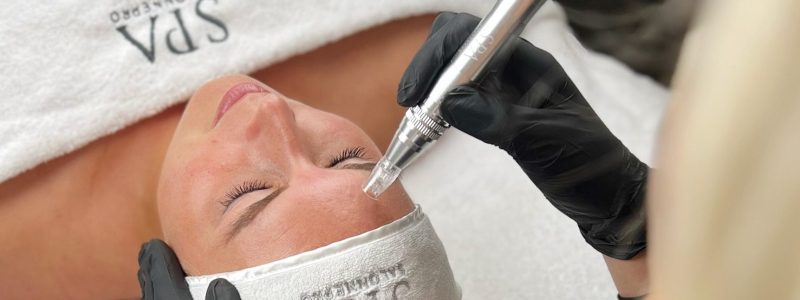 Microneedling behandeling met dermapen bij AV PMU in Wateringen